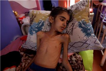 YEMEN MALNOURISHED CHILD