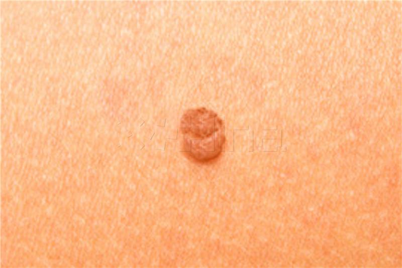 Melanoma incidence rising in Croatia