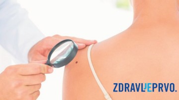 Ministarstvo: Štitite se od sunca; četvrti smo u EU po smrtnosti od melanoma 