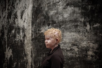 MOZAMBIQUE PHOTO SET ALBINISM