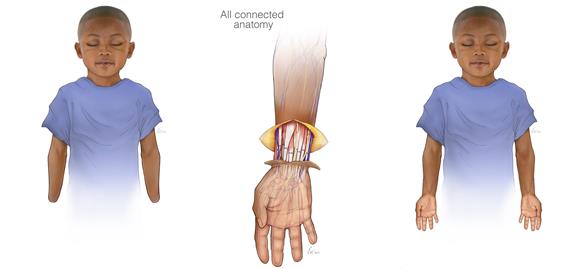 USA BILATERAL HAND TRANSPLANT CHILD