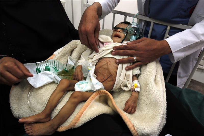 YEMEN CONFLICT MALNUTRITION