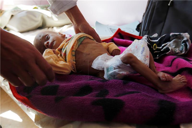 YEMEN CONFLICT MALNUTRITION