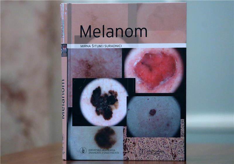 Znanstvenici razvili prvi krvni test za otkrivanje melanoma